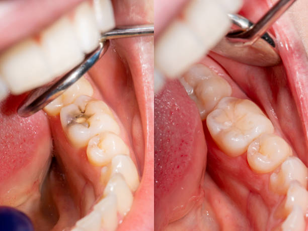 Treatment of dental caries